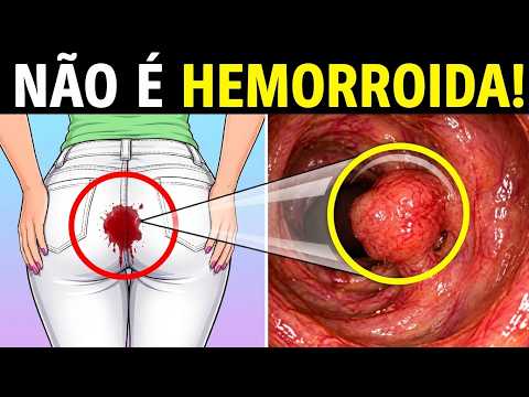 7 SINAIS INICIAIS de Câncer de Intestino | Sintomas de CÂNCER COLORRETAL que Você Precisa Conhecer